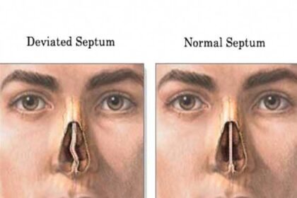 How to fix crooked septum piercing at home naturally